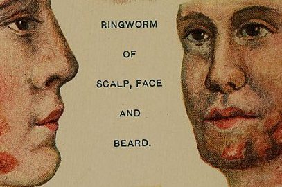 Best Home Remedies For Ringworm in Beard And On Face