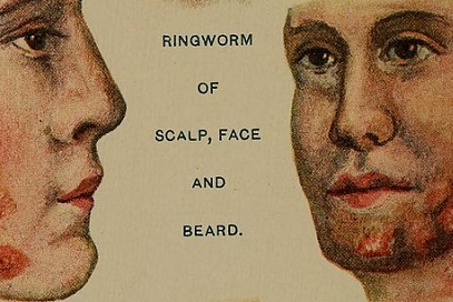 Ringworm Beard